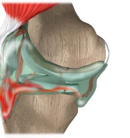 Hemartroza articulației genunchiului, tratamentul simptomelor și ceea ce este