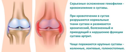 Hemartroza articulației genunchiului, semne, tratament și consecințe
