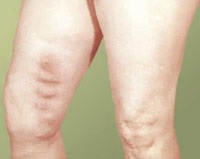 Heparin kezelésére thrombophlebitis