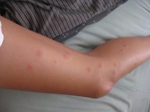 Herpesul pe picior fotografie, simptome, tratament și cauze