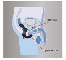 Hipertrofia prostatei este o tumoare benignă