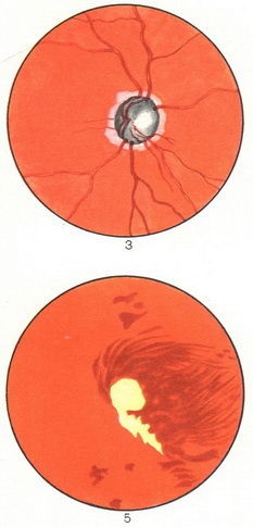 Glaucomul simptomele semnelor oculare Operația de tratament