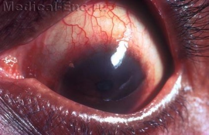 Glaukóma szem aláírja tünetek kezelésére műtét
