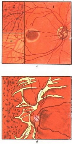 Glaucomul simptomele semnelor oculare Operația de tratament