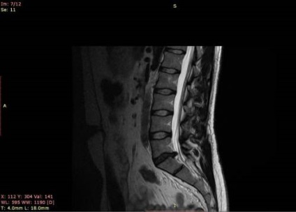 Herniated disc l5-s1 tratament, cauze și tipuri (sechestrate, mediană)