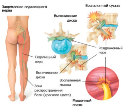 Tratamentul coloanei vertebrale lombare și recuperarea după boală