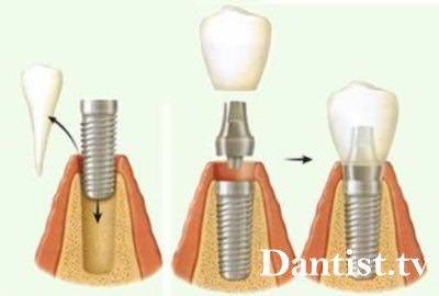 Implantarea după prețul de extracție a dinților și fotografii