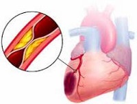 Szívinfarktus - okai, tünetei, diagnózisa és kezelése
