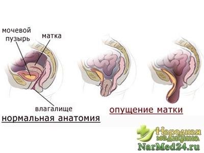 Yoga la scăderea uterului este o intuiție a femeii