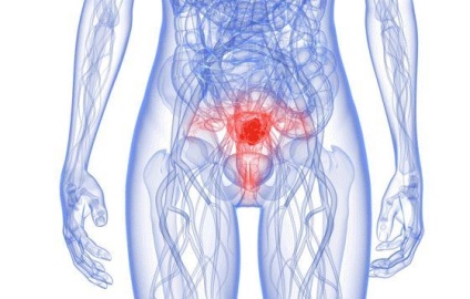 Ce semne și simptome de cancer al uterului, răspunsurile la întrebările dumneavoastră