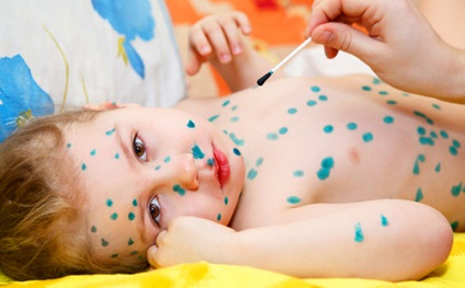 Cum se dezvoltă varicela la copii? Simptome, forme și tratament?