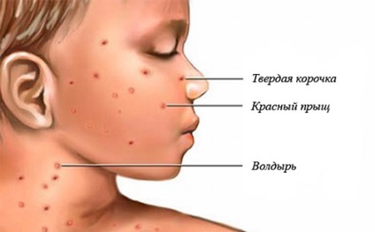 Cum se dezvoltă varicela la copii? Simptome, forme și tratament?