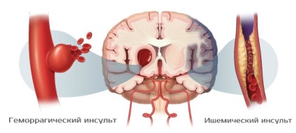 Cum să recunoașteți primele semne de accident vascular cerebral și să oferiți primul ajutor