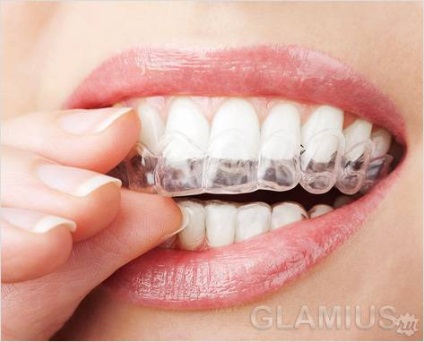 Cum se aliniază dinții fără brațe - metode de aliniere a dinților