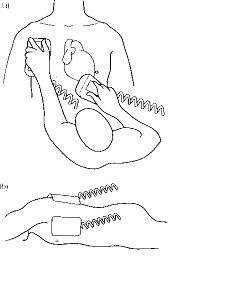 Cardioversia - cardiolog - un loc despre bolile inimii și vaselor de sânge