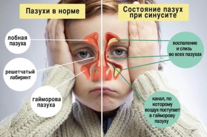 Hurutos sinusitis gyermekek tünetei és kezelése népi jogorvoslati