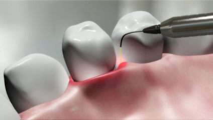 Laser stomatologie