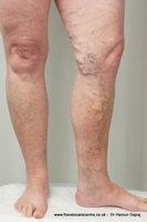Injecții terapeutice din vene varicoase pe picioare