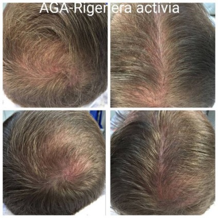 Tratamentul alopeciei (chelie) la femei și bărbați, prețurile pentru regenera activa la Moscova