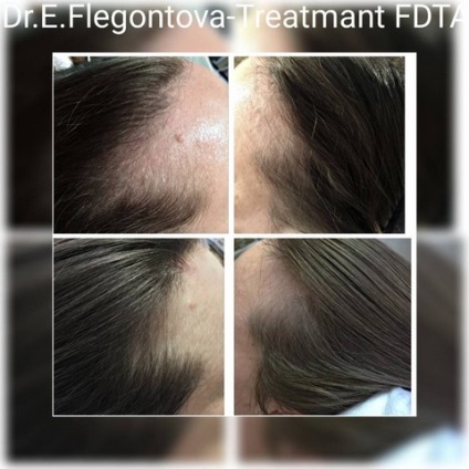 Tratamentul alopeciei (chelie) la femei și bărbați, prețurile pentru regenera activa la Moscova