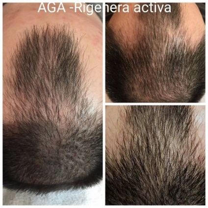 Tratamentul alopeciei (chelie) la femei și bărbați, prețurile pentru regenera activa la Moscova