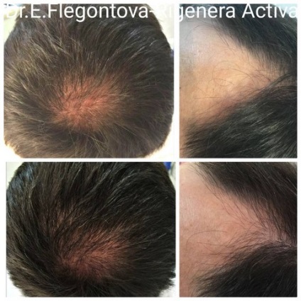 Tratamentul alopeciei (chelie) la femei și bărbați, prețurile pentru regenera activa la Moscova