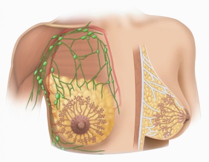 Tratamentul fibroadenomului mamar - portalul medical eurolab