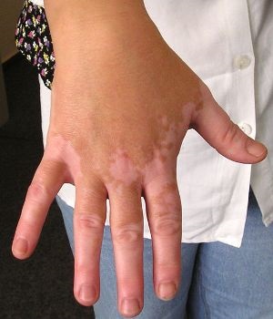 Tratamentul vitiligo malachovu