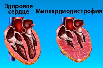 Distrofia miocardică a tipurilor, simptomelor și tratamentului inimii