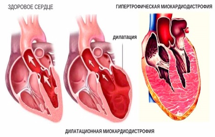 A szívizom típusú, tünetei és kezelése a szív