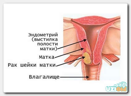 Чи може узі показати рак шийки матки, видно чи