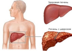 Este posibil să se vindece ciroza hepatică