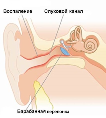 Otitis externa, ha orvoshoz okokból és módok kezelésére otitis externa