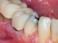 Deteriorarea canalului intern și extern a unui dinte mort