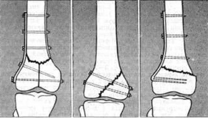 Funcționarea pe articulația genunchiului