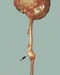 Tumor ureter simptome și tratament