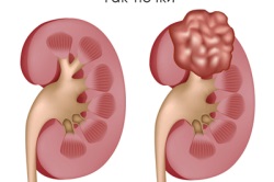 Tumorile cauzate de rinichi și clasificarea speciilor, metodele de tratament