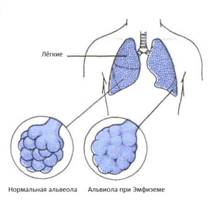 Complicațiile astmului bronșic
