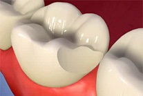 Dintele sa rupt sau rupt, traumatism dentar, deteriorare dentară, probleme dentare, limpede