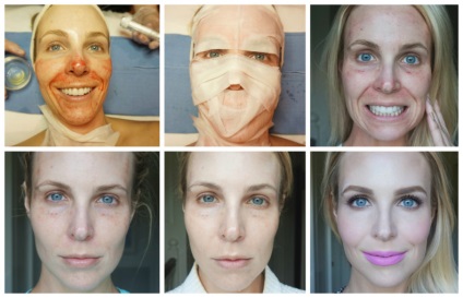 Recenzii despre plasmolifierea feței, efectul procedurii de acnee și cosuri pe piele