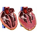 Cardiomiopatia primară și secundară este cauza morții