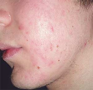 Plasmolifierea în tratamentul acneei
