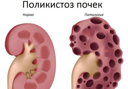 поликистоза на бъбреците при бебета и деца, симптоми и лечение