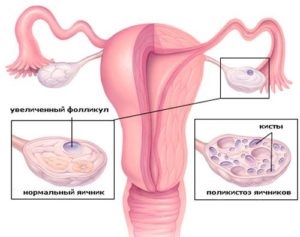 Ovarele ovariene și sarcina polichistică decât amenință, ce pericole