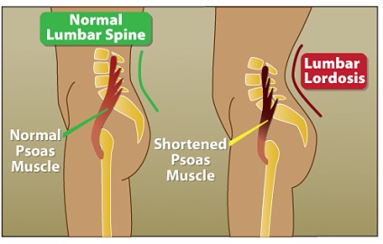 Lungimea musculară (psoas) - diagnosticul, biomecanica, exercițiile