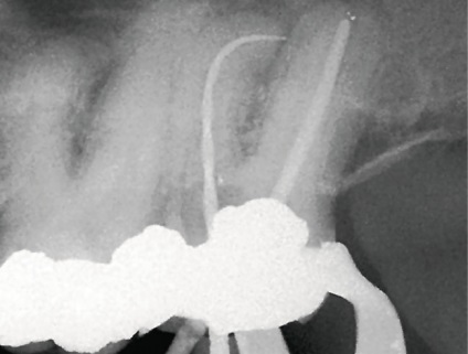 Disecția canalului bucal medial suplimentar cu un singur instrument, primul