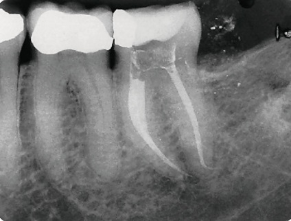 Boncolás további mediális bukkális csatorna egy eszköz, első Ukrdental