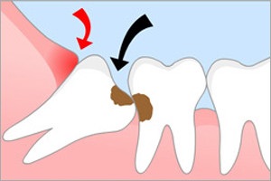 Motivele pentru extracția dinților, ce dinți sunt îndepărtați, totul despre dinți