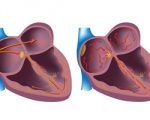 Felvételi pradaksy amelyekben beépített pacemaker