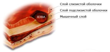 Ulcer perforat, medicament, mai mult decât periculos medicale sibiene